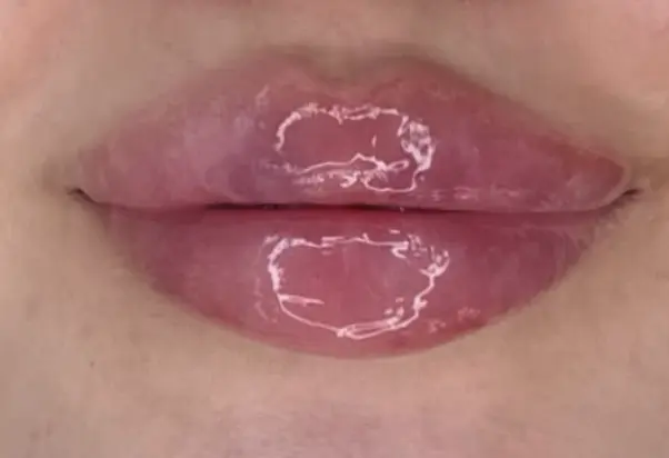 Lip filler er en behandling med hyaluronsyre, der tilfører læberne fylde, form og fugt.