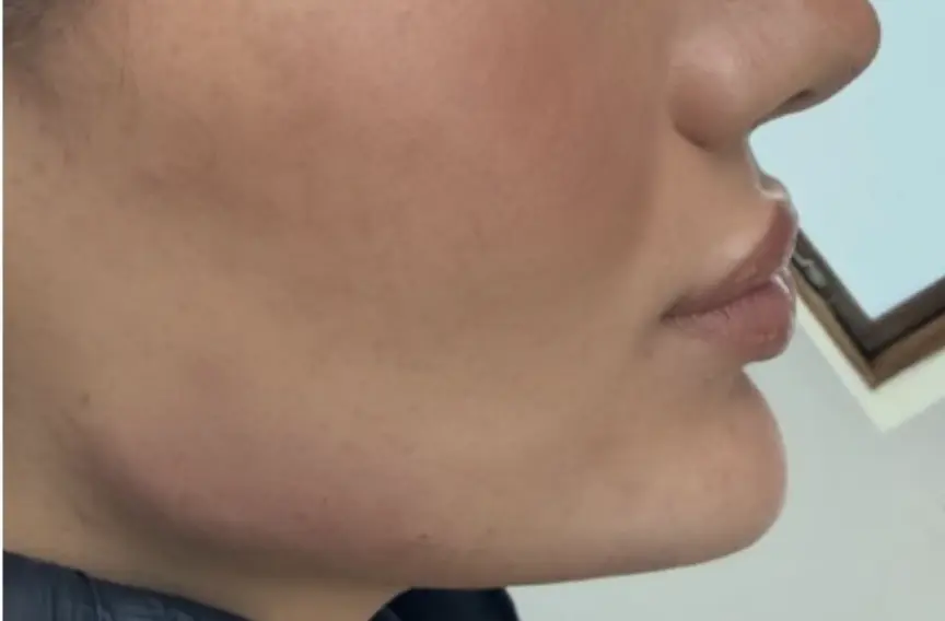 Botox I masseter (tyggemusklen)