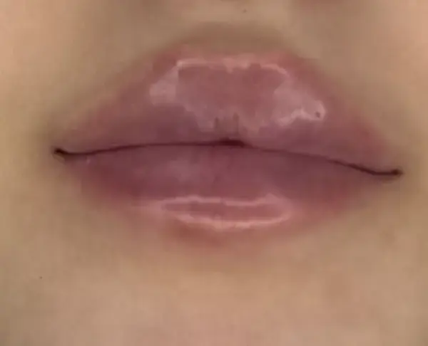 Venindetilbud på lipfillers