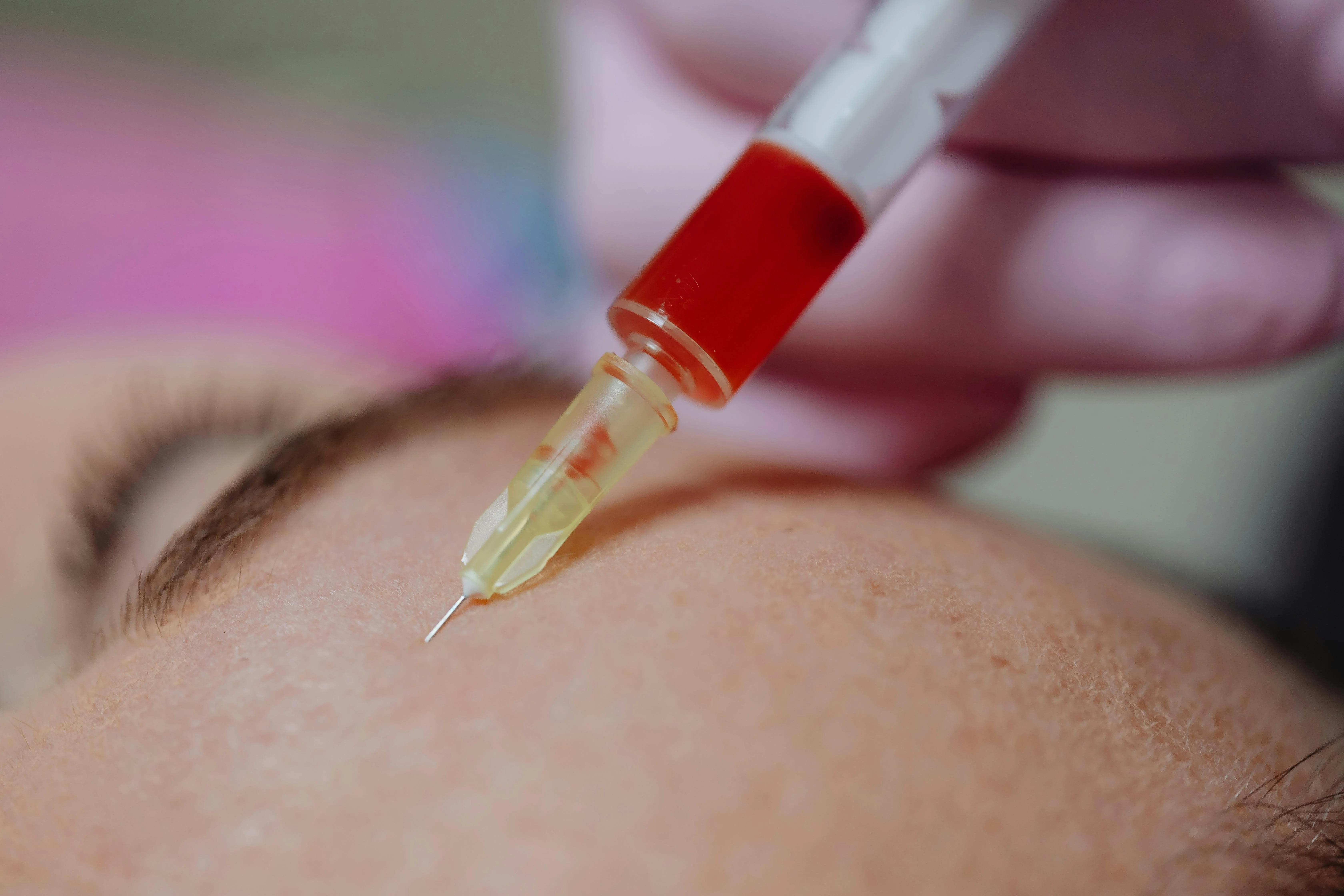 PRF i ansigtet er en behandling med kroppens eget fibrin, der stimulerer hudens fornyelse og kollagenproduktion.