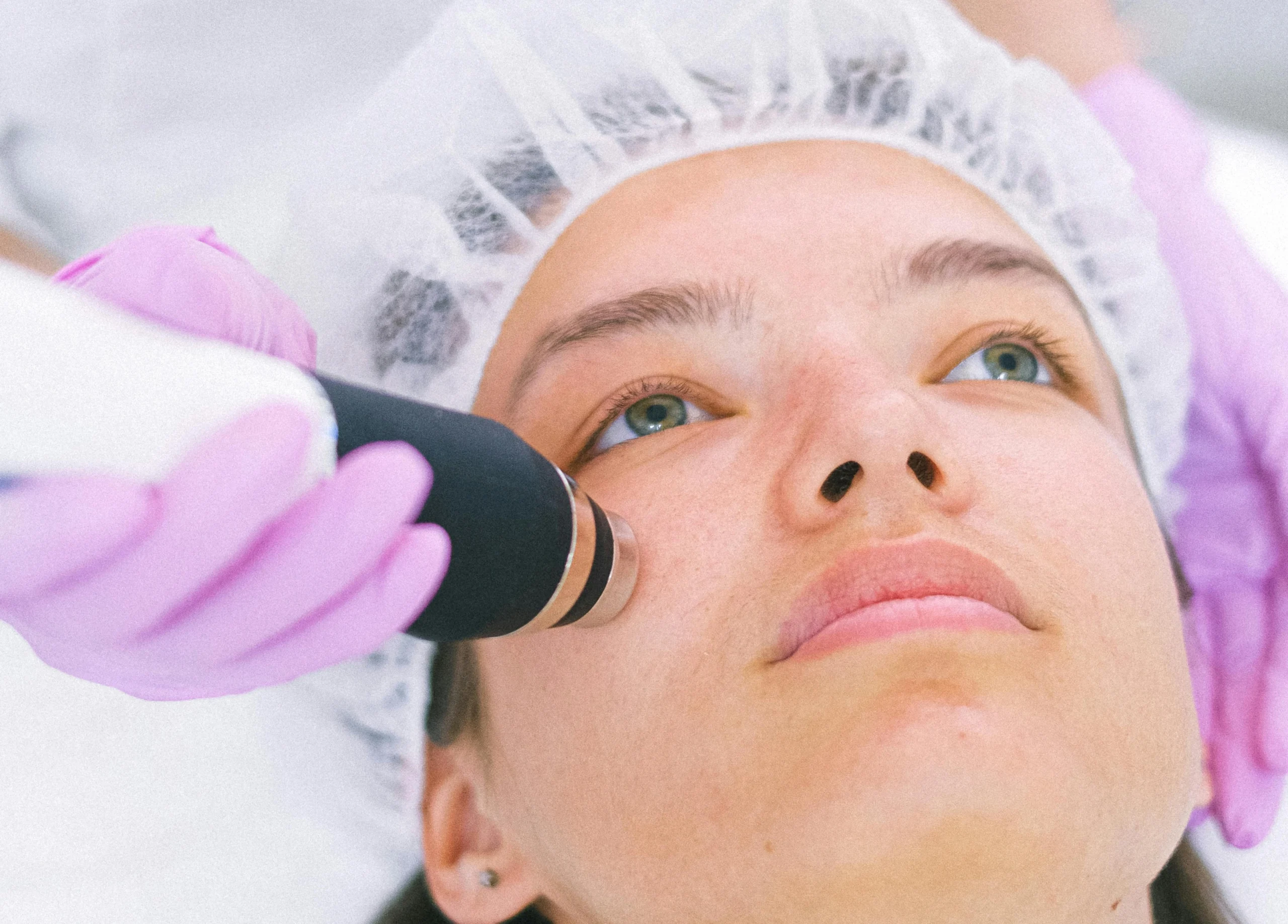 Microneedling er en behandling, der stimulerer hudens kollagenproduktion ved hjælp af små nåle.